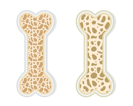 Bone density comparison illustration with healthy and osteoporosis bone structure