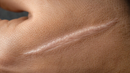 Fototapeta premium Old silver scar on a hand macro shot contrasting with surrounding skin pores and deep texture detail