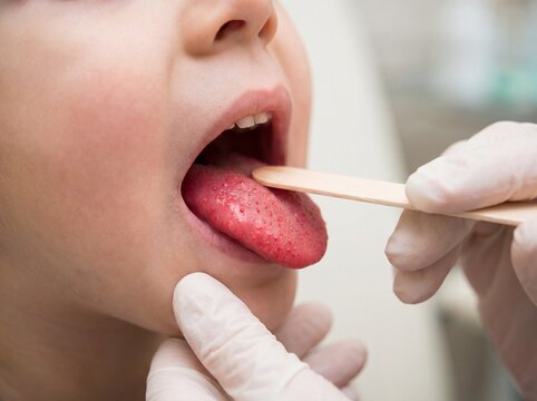 A close-up view of the open mouth of a child suffering from scarlet fever, the tongue a bright red color with small bumps showing the typical strawberry tongue appearance, professional photography.