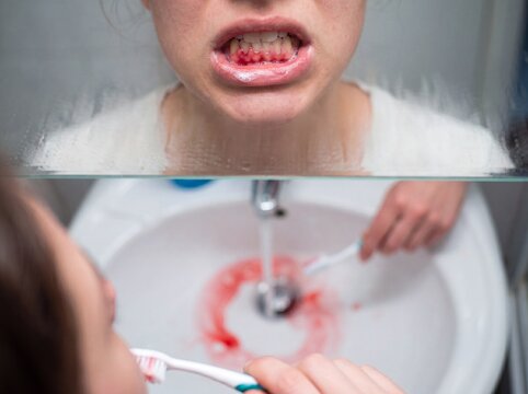 A macro detail in the bathroom mirror of a person suffering from acute gingivitis, the individual having just brushed their teeth and spitting into the white sink where the running water turns distinc