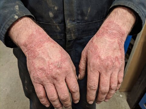 A close-up of the hands of a worker suffering from contact dermatitis, the back of the hands and wrists showing a vivid red, rough patch that traces the exact shape of the glove that triggered the rea