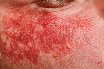 Fototapeta premium A captivating close-up of a face depicting redness due to a skin condition, symbolizing everyday challenges with skin health and the importance of self-care and attention.