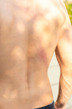Close-up of a red and swollen mosquito bite on a man's bare back outdoors during summer.