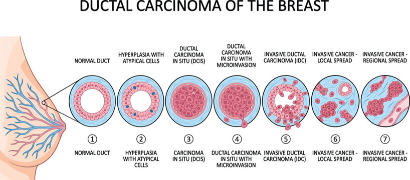 Ductal carcinoma of breast progression showing stages from normal duct to invasive cancer with regional spread, medical illustration.
