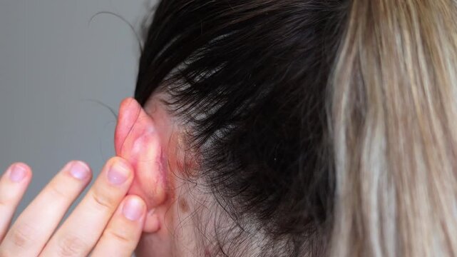 Psoriasis behind the ear, dermatological problems, skin diseases. Dandruff in the hair and behind the ears of a young woman. Dry scalp skin itches. High quality photo.