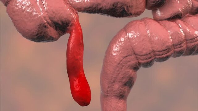 Acute appendicitis, 3D animation showing inflamed vermiform appendix with surrounding redness and swelling, camera slowly moving around abdominal structure.