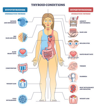 Thyroid conditions brief diagram shows a female body with thyroid gland and symptom icons comparing hypothyroidism vs hyperthyroidism, key objects, thyroid, heart, eyes. Outline diagram