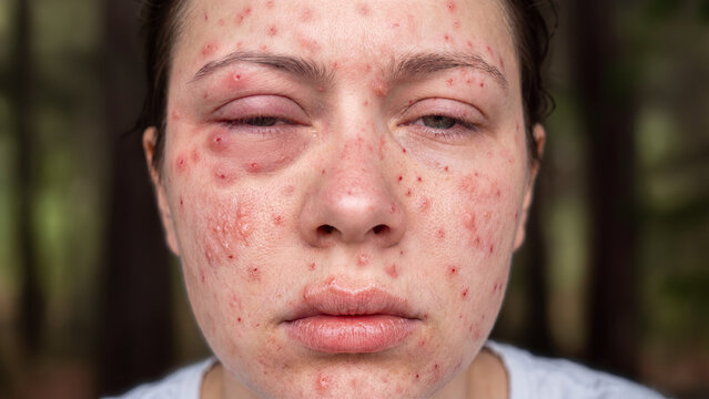 Extreme mosquito bite reaction causing massive swelling and facial inflammation