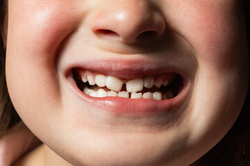 Fototapeta premium Close-up of child mouth with crooked teeth and malocclusion, highlighting pediatric orthodontics, dental alignment problems, abnormal bite, and teeth growth diagnosis.