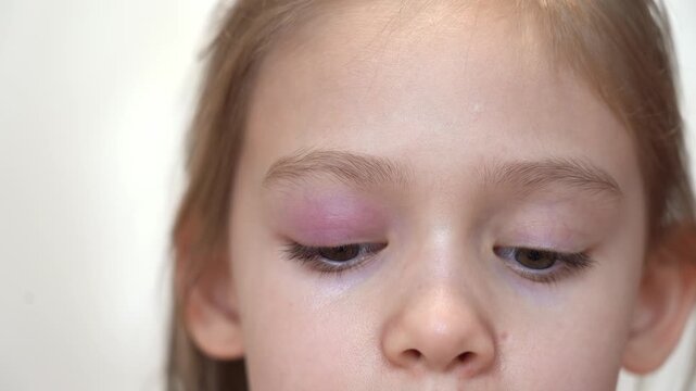 Close up of puffy child eye with barley. Swelling eyelid. Conjunctivitis. Allergy. Medicine and health care