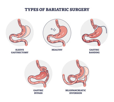 Types of bariatric surgery and stomach reduction control outline diagram, transparent background. Labeled educational scheme with digestive gastric operation methods illustration.