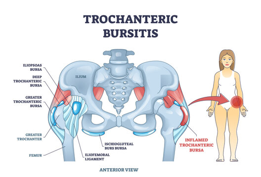 Trochanteric bursitis as bursa inflammation located in hip outline diagram, transparent background. Labeled educational medical anatomy scheme.
