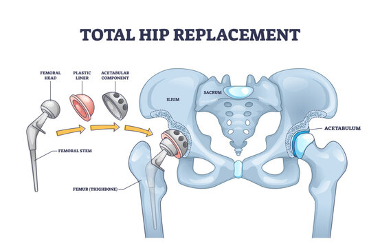 Total hip replacement surgery with anatomical acetabular prosthesis outline diagram, transparent background. Labeled educational medical operation process description.
