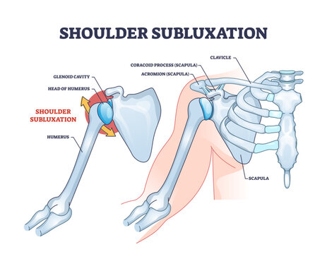 Shoulder subluxation as partial dislocated arm joint problem outline diagram, transparent background. Labeled educational medical scheme with body skeletal anatomy and dislocated bones illustration.