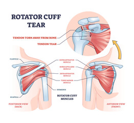 Obraz premium Rotator cuff tear as shoulder muscle trauma or arm injury outline diagram, transparent background. Labeled educational upper body anatomy with medical tendon torn away from bone illustration.