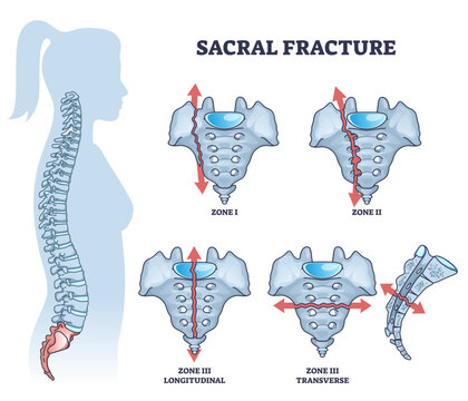 Sacral fracture with backbone skeletal trauma or injury types outline diagram, transparent background. Labeled educational scheme with broken longitudinal and transverse zone illustration.