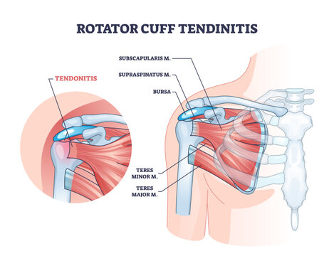 Rotator cuff tendinitis as shoulder muscular inflammation outline diagram, transparent background. Labeled educational anatomical structure and medical description.
