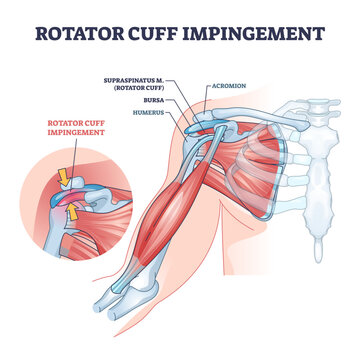 Rotator cuff impingement and anatomical shoulder muscle outline diagram, transparent background. Labeled educational muscular and skeletal description with injury example illustration.