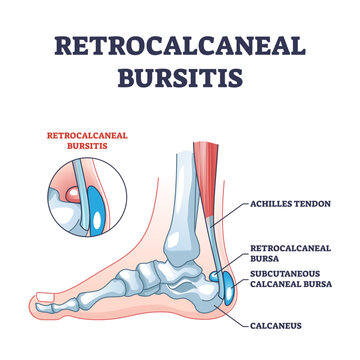 Retrocalcaneal bursitis as ankle achilles tendon bursa outline diagram, transparent background. Labeled educational medical condition with ligament or achilles tendon retrocalcaneal.