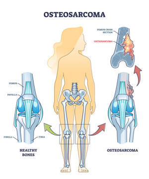 Osteosarcoma bone tumor as osteogenic sarcoma skeleton cancer outline diagram, transparent background. Labeled educational medical scheme with human knee anatomy or femur cross section illustration.
