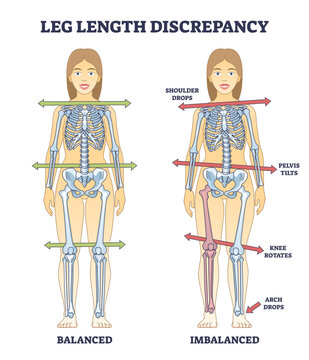 Leg length discrepancy condition with imbalanced skeleton outline diagram, transparent background. Labeled educational scheme with bones asymmetry and comparison with balanced body illustration.
