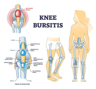 Knee bursitis condition with fluid filled bursa in leg joint outline diagram, transparent background. Labeled educational medical liquid growth anatomy scheme.