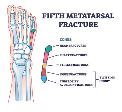 Fifth metatarsal or foot little finger fracture after injury outline diagram, transparent background. Labeled educational scheme with feet trauma after twisting motion illustration.