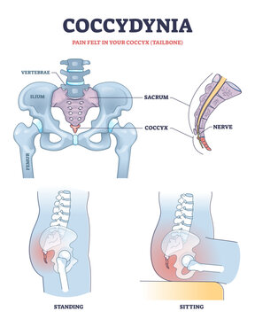 Coccydynia as pain felt in coccyx or tailbone anatomical outline diagram, transparent background. Labeled educational back bone structure and painful nerve in standing.