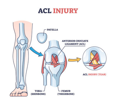 ACL injury or trauma as tear or sprain of anterior cruciate outline concept, transparent background. Labeled educational leg or knee pain anatomical explanation.