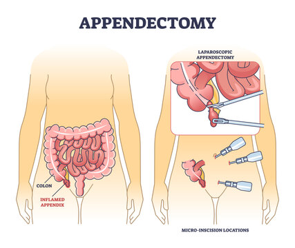 Appendectomy diagram shows the inflamed appendix, colon, and laparoscopic surgery tools in a clear medical outline, transparent background.