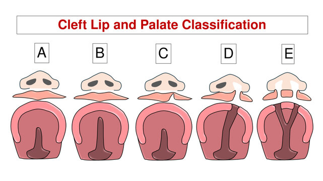 Cleft Lip and Palate Anatomical Classification Chart, Congenital Lip and Palatal Defect Severity Groups and Oral Pathology Vector Diagram