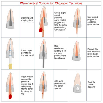 Warm Vertical Compaction Obturation Technique Grid, Endodontic Root Canal Filling Steps, Gutta Percha Downpack and Backfill Vector Infographic