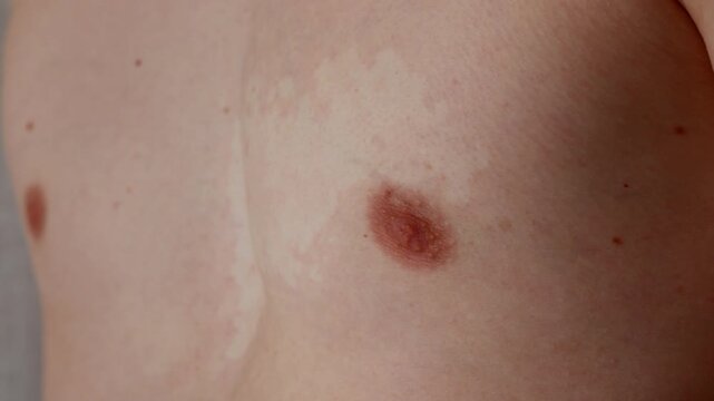 Close up of vitiligo skin patches on chest, dermatology concept