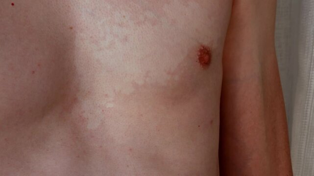 Vitiligo on human chest, skin pigmentation disorder close up