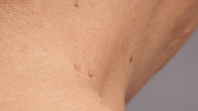 Close up view of human skin showing warts and skin tag