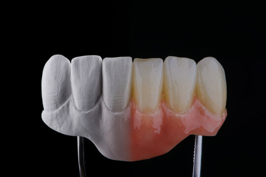 Two stages of making dental zirconium prosthesis on titanium abutments. Dental care concept.