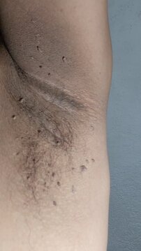 Clinical Macro Close Up of Skin Tags and Warts Under a Male Armpit