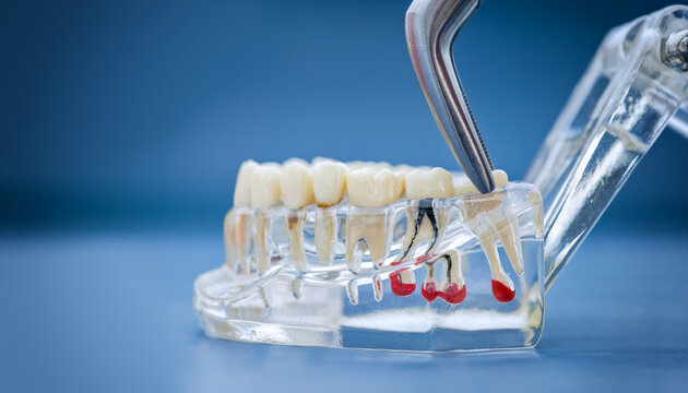 Transparent dental teaching model of the jaw with tooth pathologies, cysts, and surgical forceps on a blue background. Tooth extraction concept.