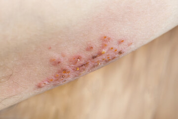Fototapeta premium Woman with shingles on the skin she feels very painful. High quality photo