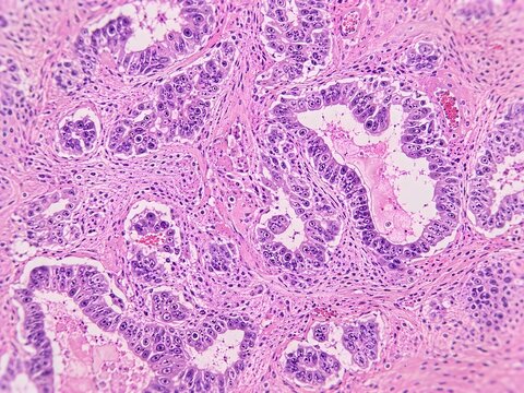 Histopathology of human lung adenocarcinoma stained with H&E, demonstrating invasive acinar glandular architecture, nuclear pleomorphism, desmoplastic stromal reaction, intraluminal mucinous debris.