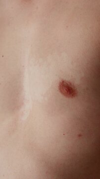 Vitiligo awareness concept, close up of skin depigmentation on chest.