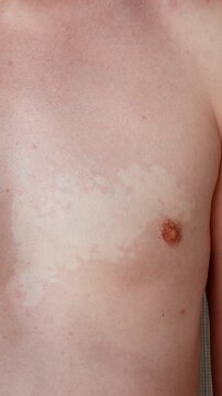 Vitiligo on human chest, visible skin depigmentation disorder close up.