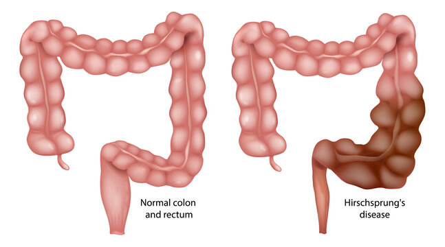 Hirschsprung Disease Medical Illustration Comparing Normal Colon and Congenital Aganglionic Megacolon. Colonic Dilation and Bowel Obstruction
