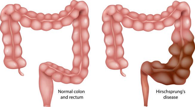 Hirschsprung Disease Medical Illustration Comparing Normal Colon and Congenital Aganglionic Megacolon. Colonic Dilation and Bowel Obstruction
