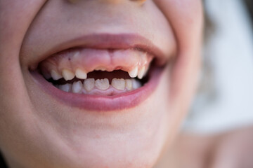Fototapeta premium Close up of a boy smiling with missing teeth 