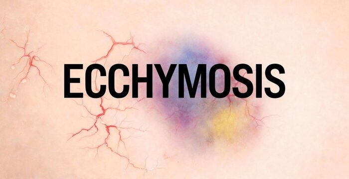 Ecchymosis bruise on human skin closeup.