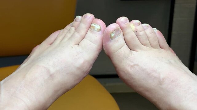 Onychomycosis. A dangerous fungal infection of the toenails of a person sitting in a doctor's examination chair. Disease and detachment of the nail plate. Close-up