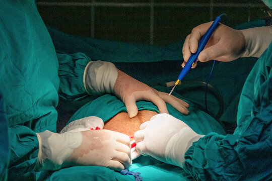 Surgeons performing cesarean section in operating room. Medical team working under sterile conditions during childbirth surgery in hospital setting.