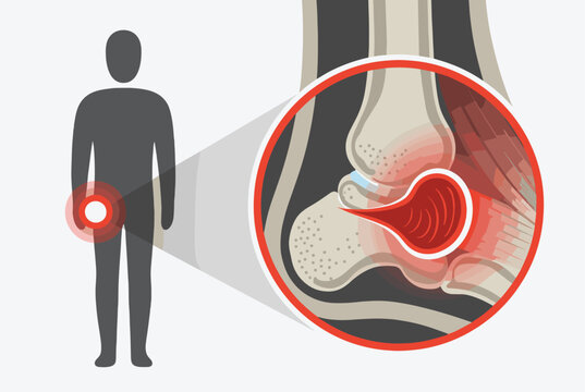 Medical illustration showing a human silhouette with hip pain and a magnified view of the joint suffering from inflammation or arthritis.