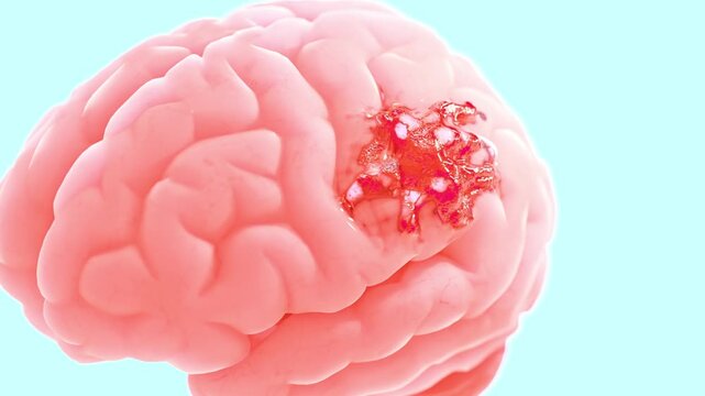 Brain damage or cancer tumor malignant cells growth and spreading. Designed to pastel color and minimal concept. Can be used in medical elements related meningioma or neurological disease, 3D Render.